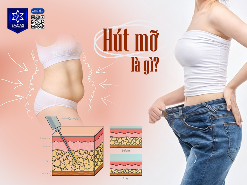 Có Nên Hút Mỡ Để Giảm Cân?