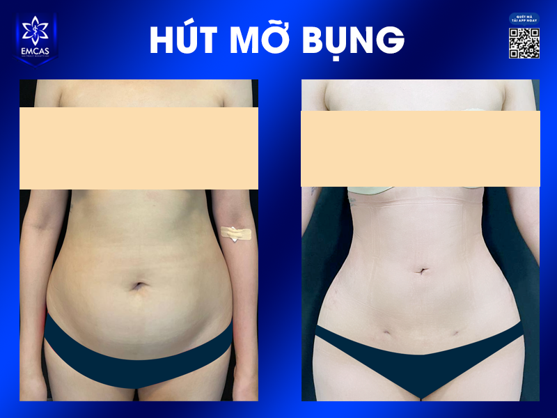 5 Lợi Ích Khi Chọn Hút Mỡ