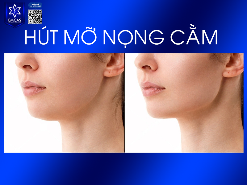 Hút Mỡ Nọng Cằm - Phương Pháp Làm Thon Gọn Khuôn Mặt Nhanh Chóng