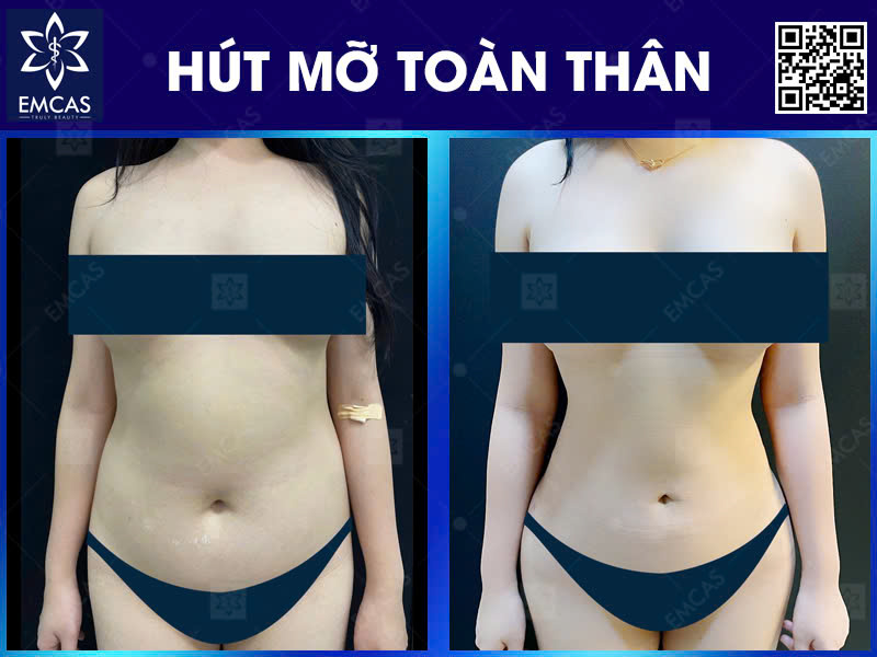 Tìm Hiểu Kỹ Hơn Về Các Dịch Vụ Hút Mỡ Hiện Nay