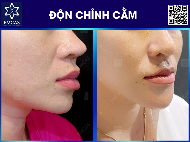 Quy Trình Độn Cằm Diễn Ra Như Thế Nào?