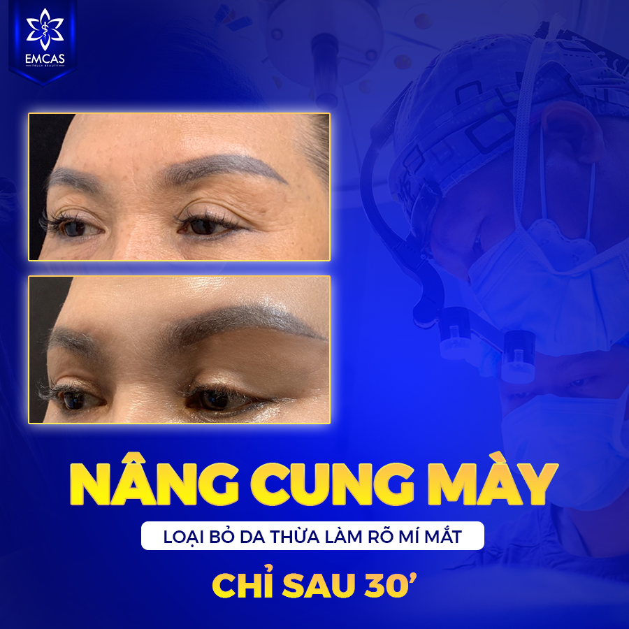 Nâng Cung Chân Mày Là Gì?