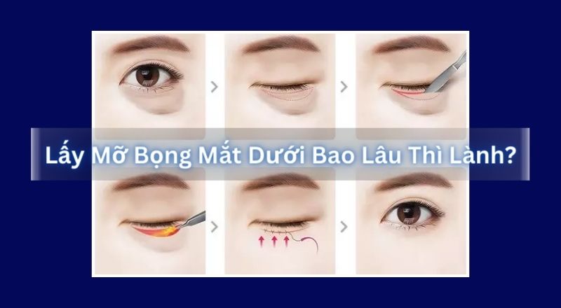 Lấy Mỡ Bọng Mắt Dưới Bao Lâu Thì Lành?