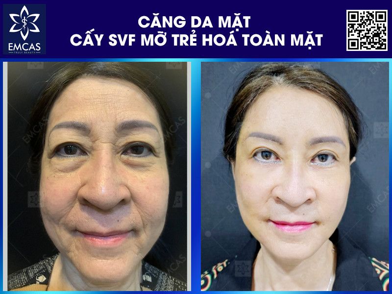 Lợi Ích Của Phương Pháp Căng Da Mặt