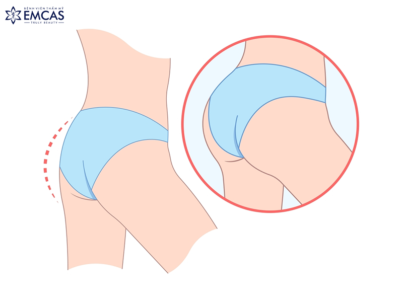 Bảo Quản Vẻ Đẹp - Nâng Mông Bằng Mỡ Tự Thân Giữ Được Bao Lâu?