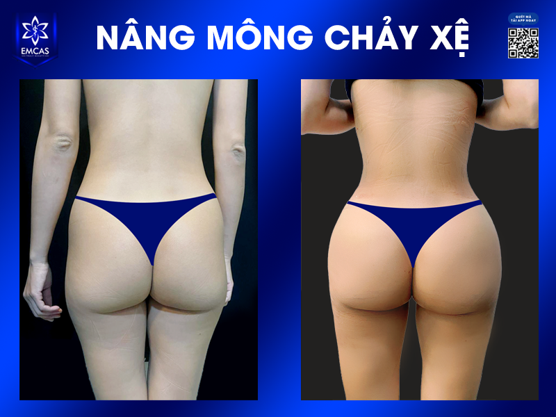 Khắc Phục Tình Trạng Vòng 3 Chảy Xệ