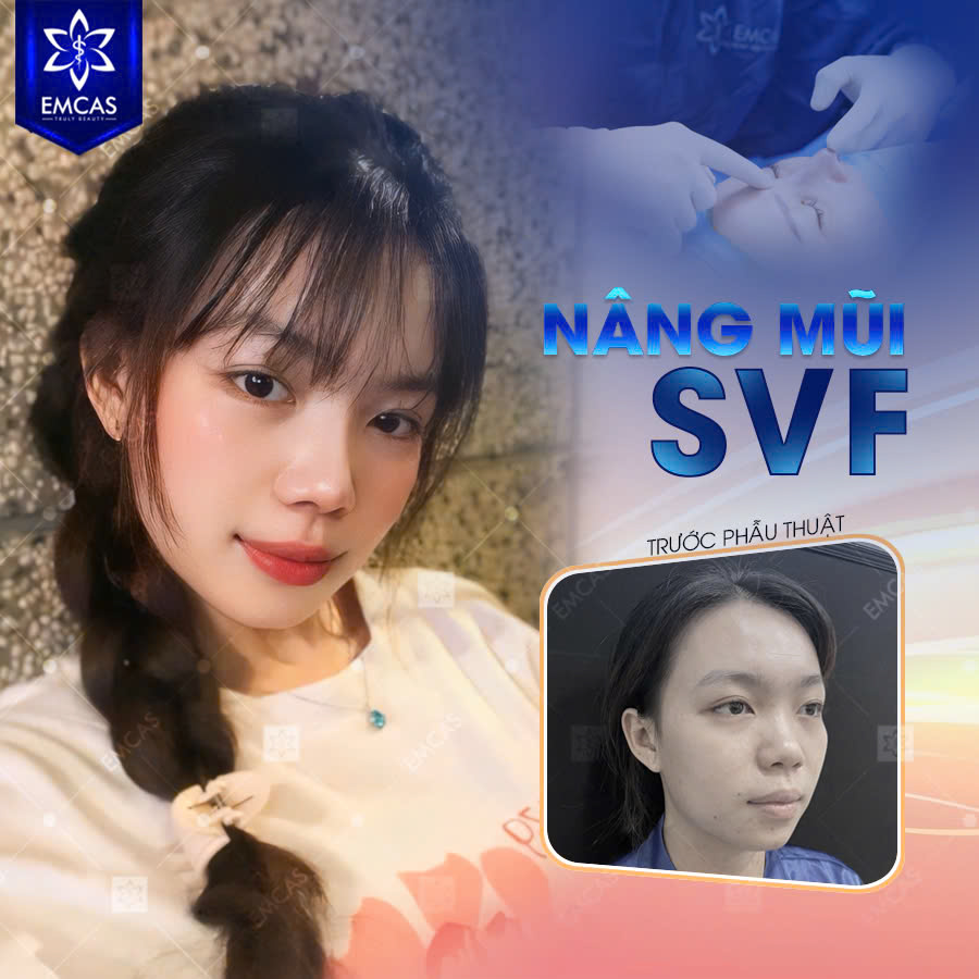 Nâng Mũi SVF Là Gì? Có Ưu Điểm Gì So Với Phương Pháp Khác?