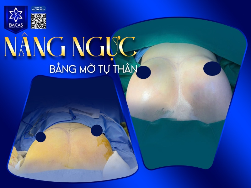 Sau khi nâng ngực bằng mỡ tự thân, việc chăm sóc đúng cách đóng vai trò quan trọng giúp tăng tỷ lệ mỡ sống, duy trì dáng ngực đẹp và hạn chế biến chứng.