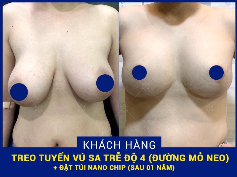 Bệnh viện thẩm mỹ EMCAS là địa chỉ nâng vòng một uy tín được nhiều khách hàng tin tưởng và lựa chọn thẩm mỹ ngực trong 10 năm qua.