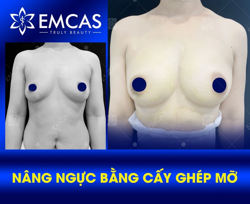Nâng ngực bằng mỡ tự thân là phương pháp nâng ngực không phẫu thuật được nhiều chị em lựa chọn nhờ tính an toàn và vẻ đẹp tự nhiên.