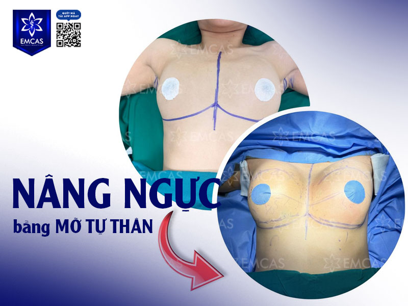 Nâng ngực bằng mỡ tự thân sử dụng chính mỡ thừa từ các vùng như bụng, đùi hoặc lưng, sau khi được xử lý và chọn lọc sẽ cấy vào vùng ngực nhằm tăng vòng 1 không phẫu thuật một cách hài hòa.
