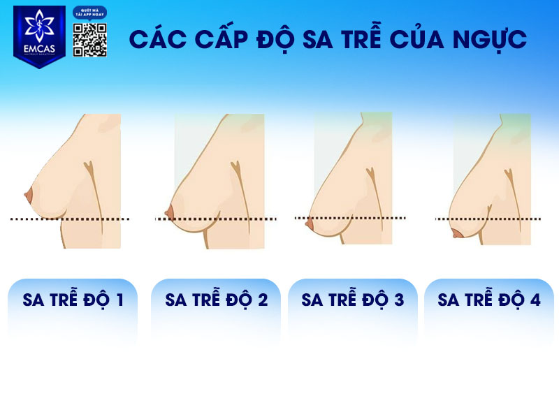 Trong y khoa thẩm mỹ, sa trễ ngực được phân loại dựa trên khoảng cách từ hõm xương ức đến đầu ti.