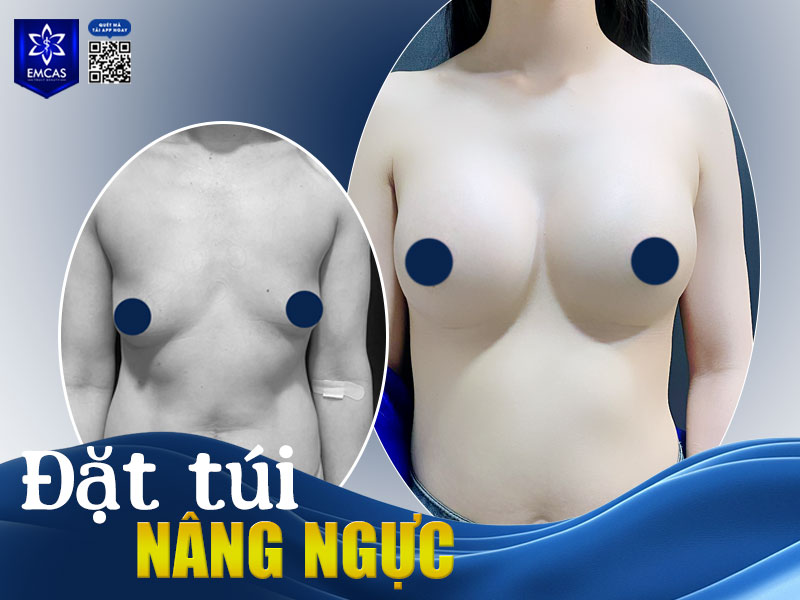 Bạn có thể cân nhắc nâng ngực khi cảm thấy mất tự tin về ngoại hình, khó lựa chọn trang phục phù hợp hoặc mong muốn cải thiện đường cong cơ thể một cách rõ rệt hơn.