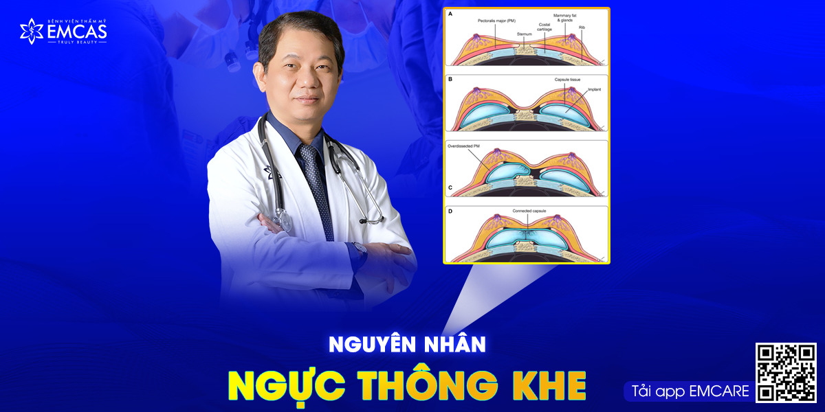 Nguyên Nhân Ngực Thông Khe