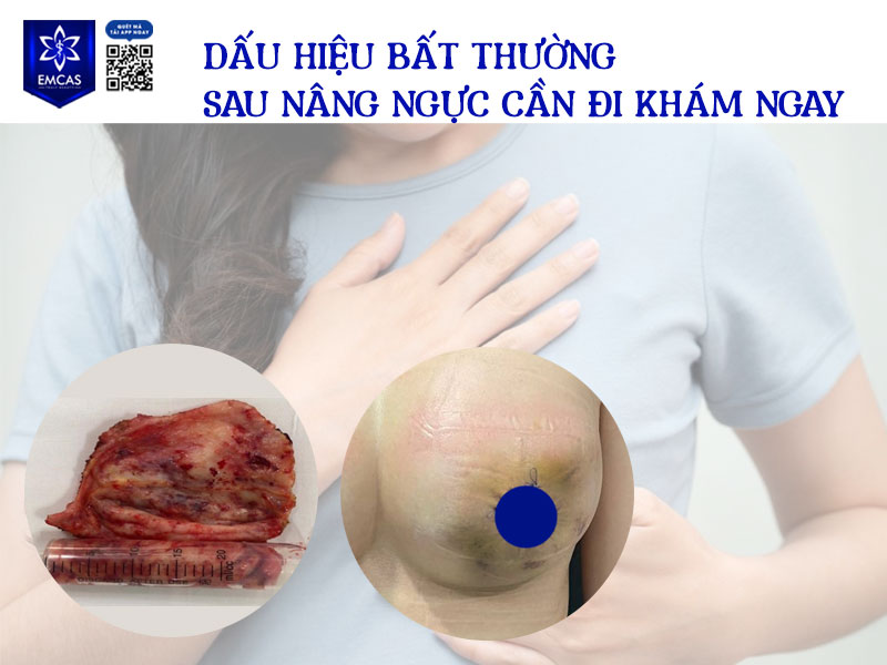 Sau nâng ngực, giai đoạn chăm sóc hậu phẫu đóng vai trò quyết định đến kết quả lâu dài và mức độ hồi phục của cơ thể