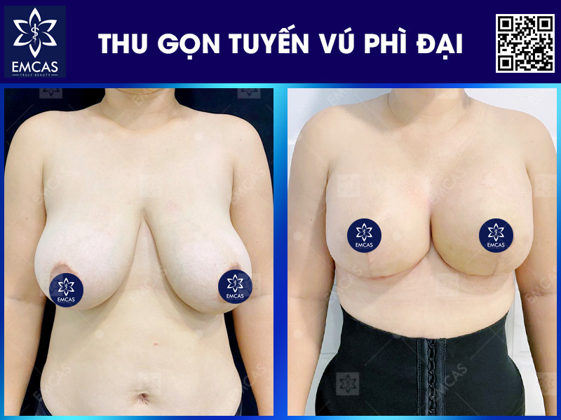 Thu gọn tuyến vú phì đại là giải pháp phù hợp cho những trường hợp vòng 1 quá khổ, gây ảnh hưởng đến thẩm mỹ và sinh hoạt.