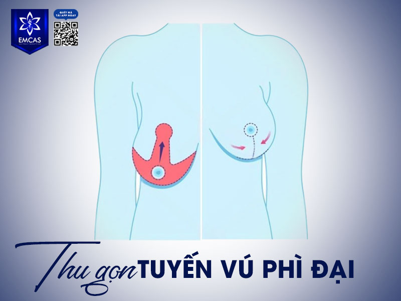 Thu gọn tuyến vú phì đại là quá trình phẫu thuật giúp loại bỏ phần mô tuyến vú, mô mỡ và da dư thừa ở bầu ngực, từ đó giảm kích thước vòng 1. 