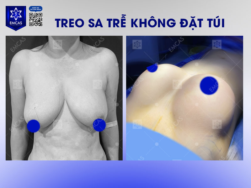 Treo sa trễ không đặt túi là giải pháp thẩm mỹ giúp nâng cao bầu ngực chảy xệ mà vẫn giữ nguyên thể tích tự nhiên của vòng 1.