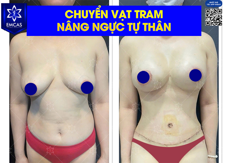 Túi Ngực Tự Thân - Nâng Ngực An Toàn, Tương Thích Với Cơ Thể