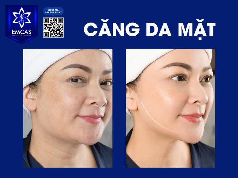 Lợi Ích Của Phương Pháp Căng Da Mặt