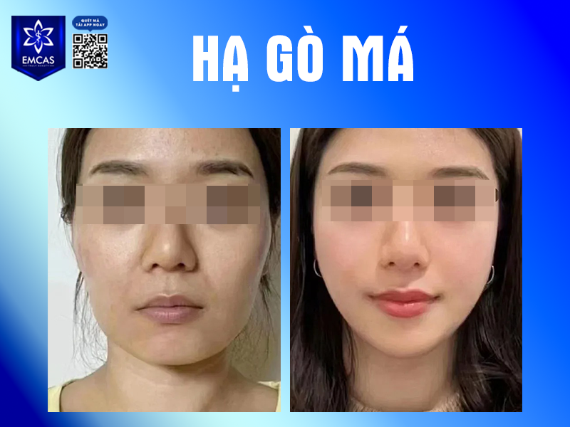 Gò Má Cao Có Xấu Không? Khi Nào Cần Hạ Gò Má?