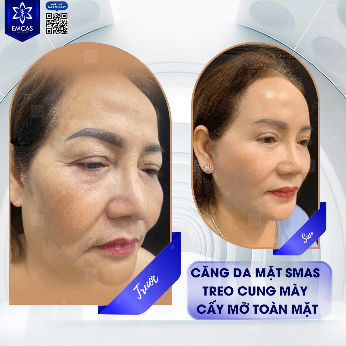 Căng Da Mặt SMAS - Bí Quyết Giữ Gìn Thanh Xuân