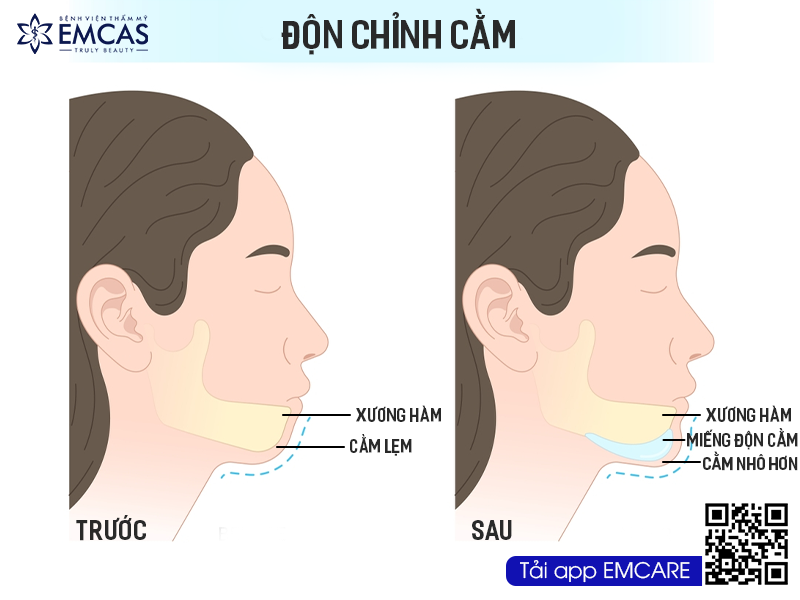 Quy Trình Độn Cằm Diễn Ra Như Thế Nào?