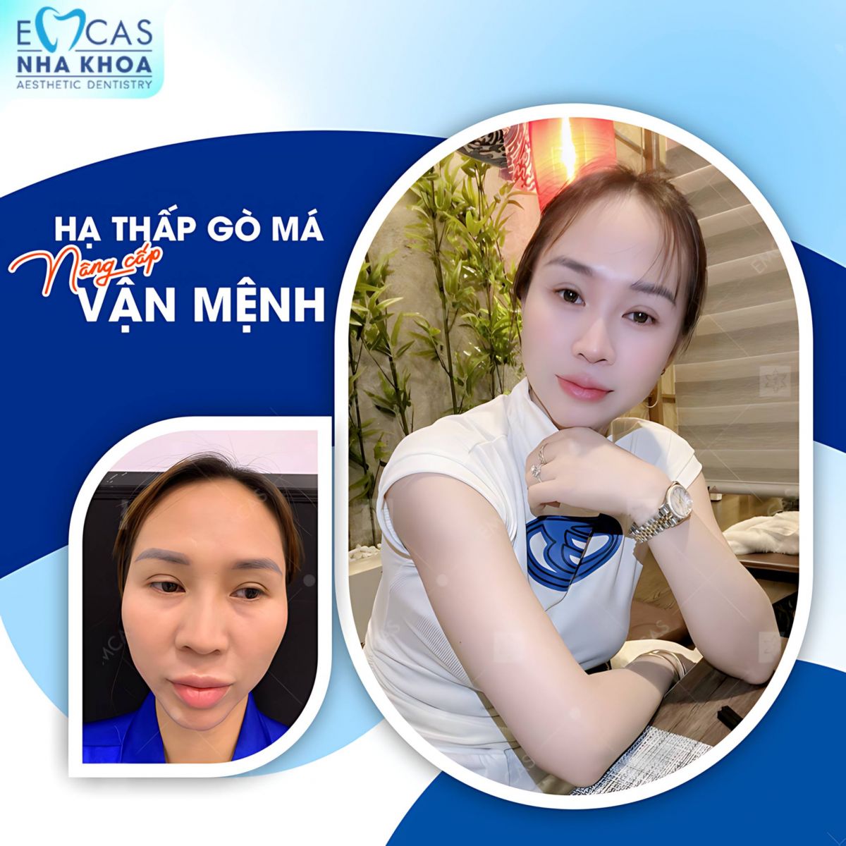 Tại Sao Nên Chọn Dịch Vụ Hạ Gò Má Lefort Để Cải Thiện Nhan Sắc?
