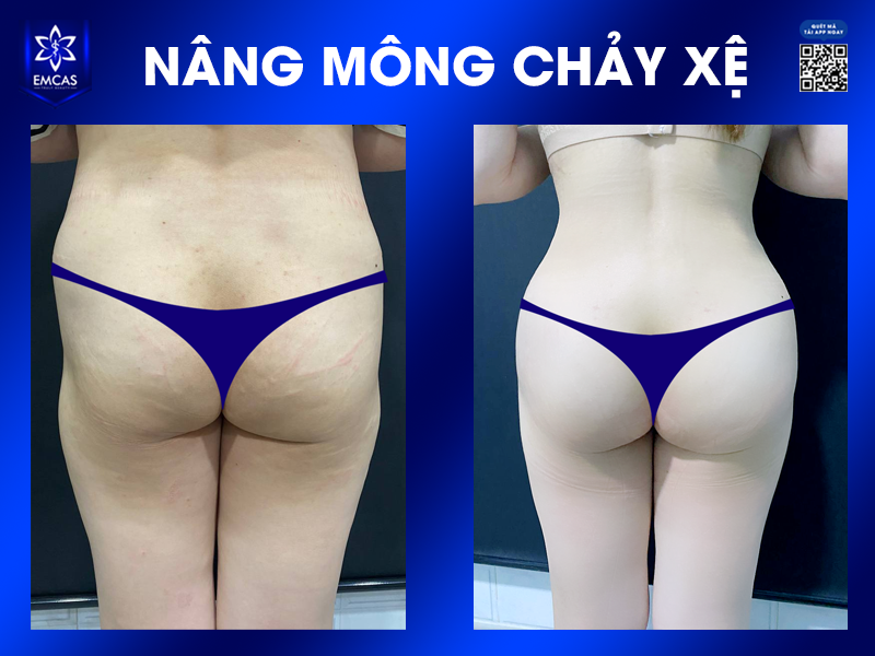 Khắc Phục Tình Trạng Vòng 3 Chảy Xệ