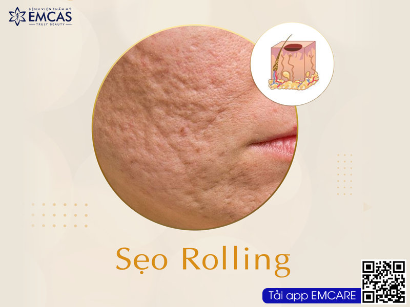 Ứng Dụng Công Nghệ Tế Bào Gốc Trong Điều Trị Sẹo Rỗ