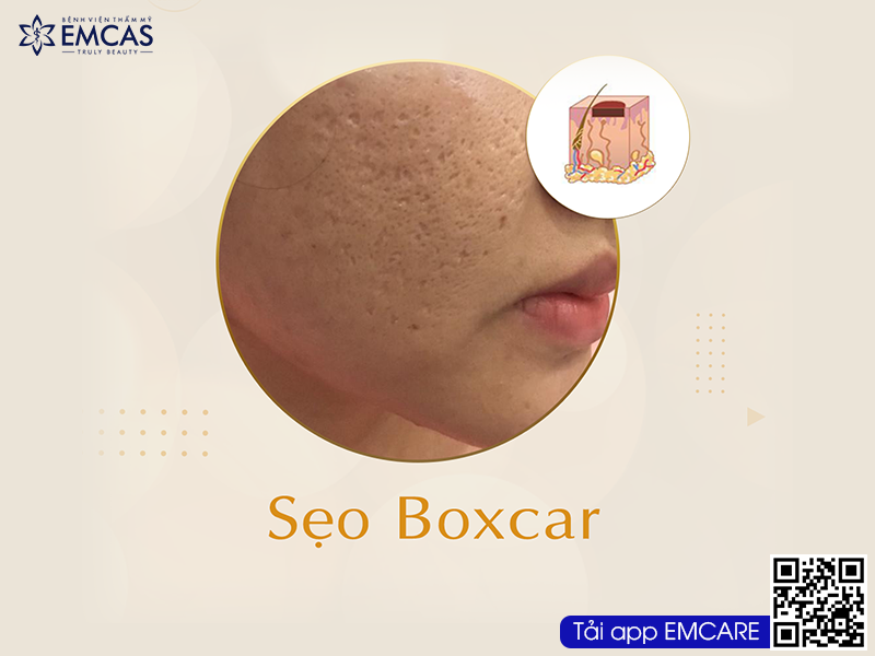 Ứng Dụng Công Nghệ Tế Bào Gốc Trong Điều Trị Sẹo Rỗ