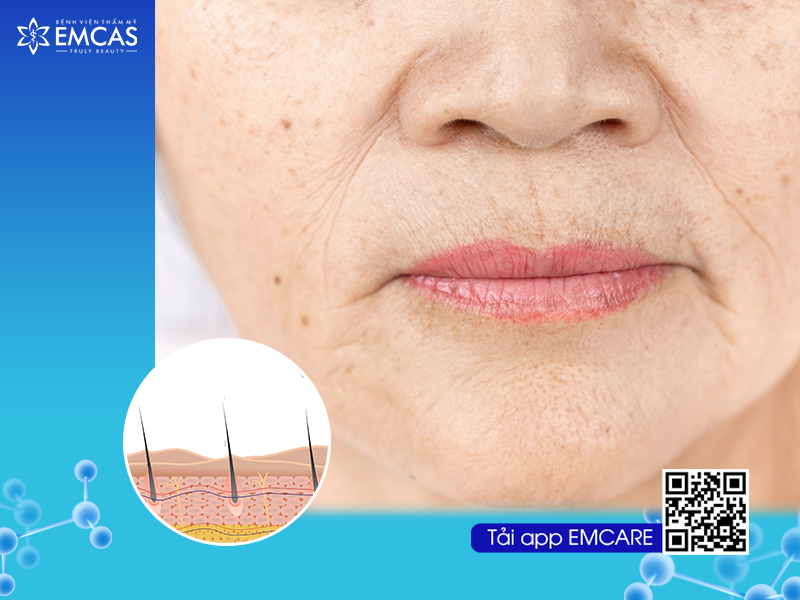 Ứng Dụng Công Nghệ Tế Bào Gốc Trong Điều Trị Nếp Nhăn