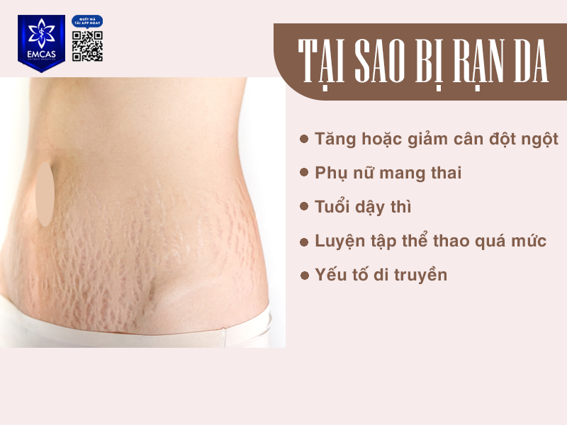 Tại Sao Da Bị Rạn Và Cách Phòng Tránh