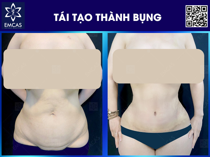 Tái Tạo Thành Bụng - Giải Pháp Cho Vòng Eo Thon Gọn