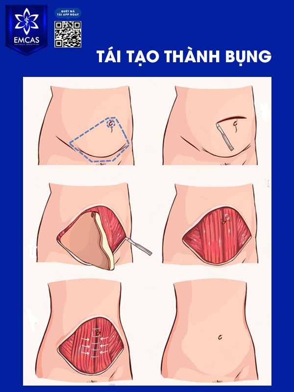 Tái Tạo Thành Bụng Có Ảnh Hưởng Đến Việc Mang Thai?