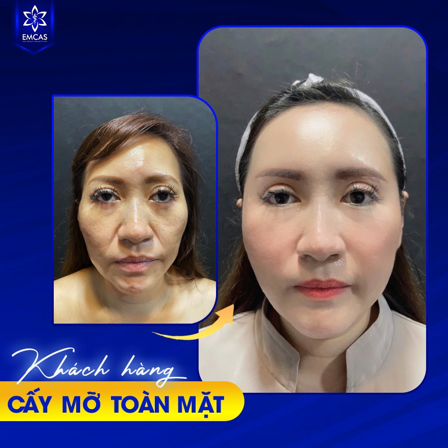 TIÊM MỠ TOÀN MẶT