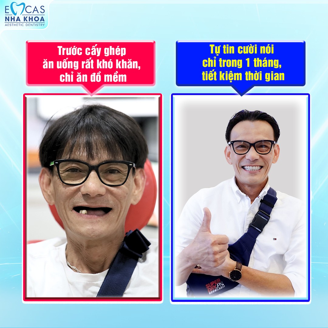 Ứng Dụng SVF Trong Trồng Răng Implant