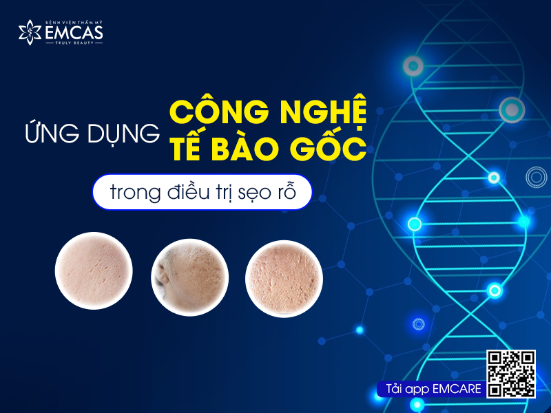 Ứng Dụng Công Nghệ Tế Bào Gốc Trong Điều Trị Sẹo Rỗ