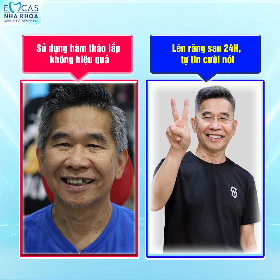 Ứng Dụng SVF Trong Trồng Răng Implant