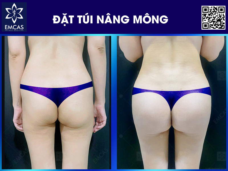Đặt Túi Mông - Giải Pháp Nhanh Chóng Để Sở Hữu Vòng 3 Đầy Đặn