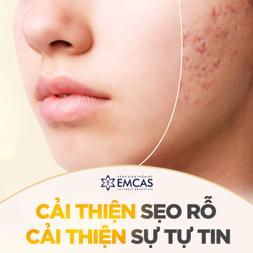 Ứng Dụng Công Nghệ Tế Bào Gốc Trong Điều Trị Sẹo Rỗ