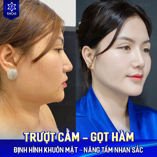 Tất Tần Tật Về Gọt Hàm: Quy Trình, Ưu Điểm và Chăm Sóc
