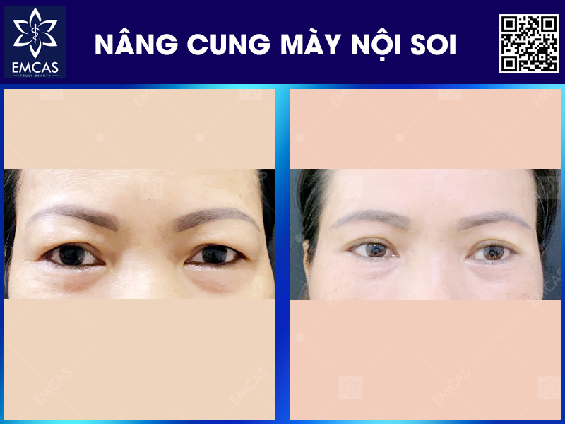 Nâng Cung Chân Mày Có Tác Dụng Gì?