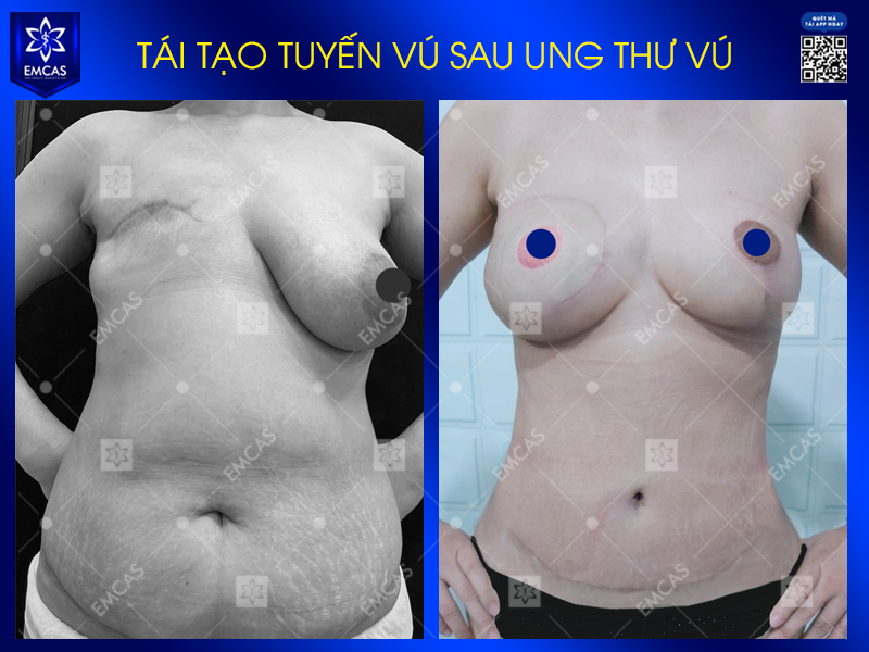 Tái Tạo Tuyến Vú An Toàn – Phục Hồi Vẻ Đẹp Cho Phụ Nữ Sau Ung Thư