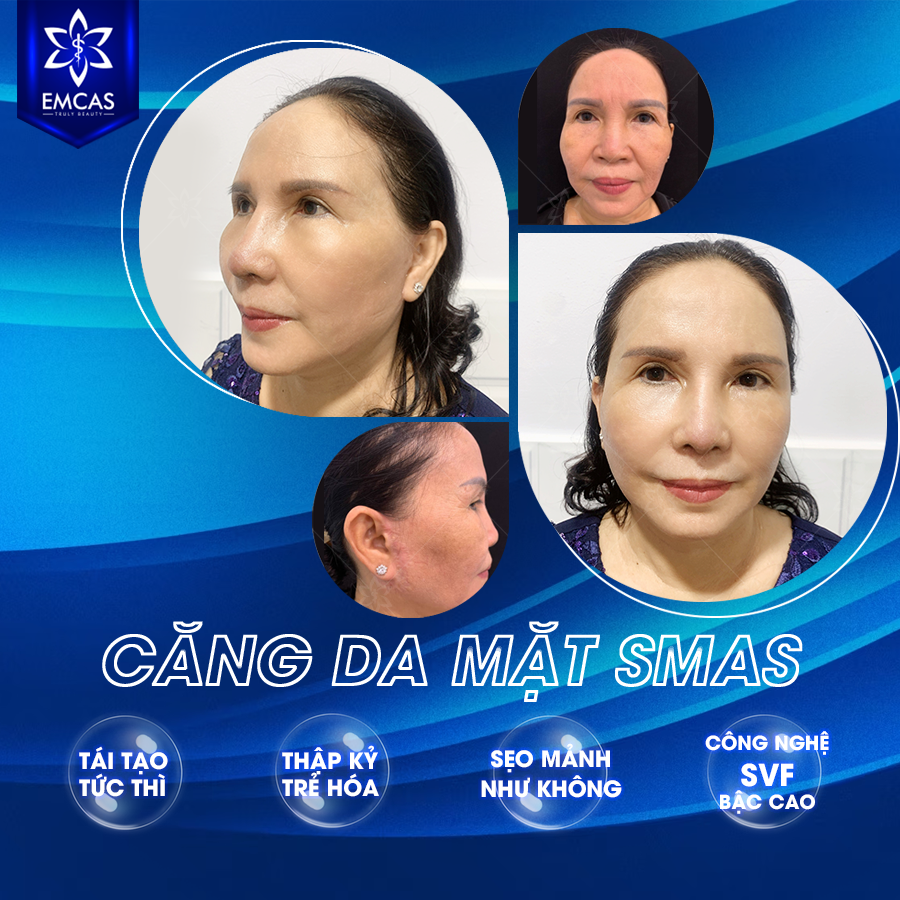 Ưu Điểm Khi Thực Hiện Căng Da Mặt Tại EMCAS