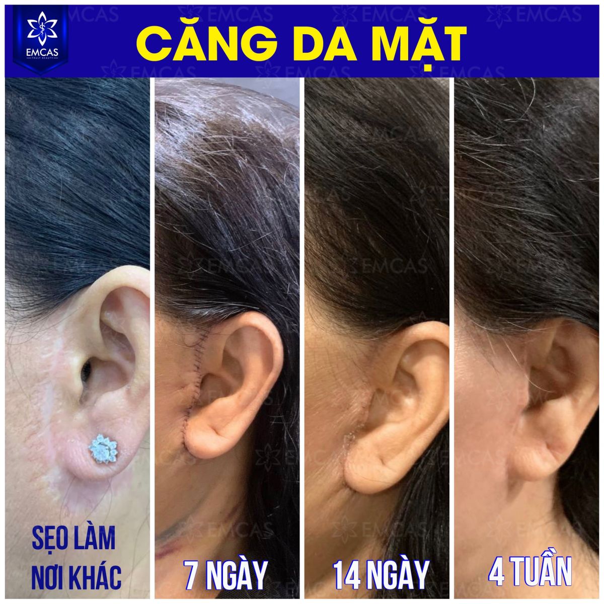 Lợi Ích Của Phương Pháp Căng Da Mặt
