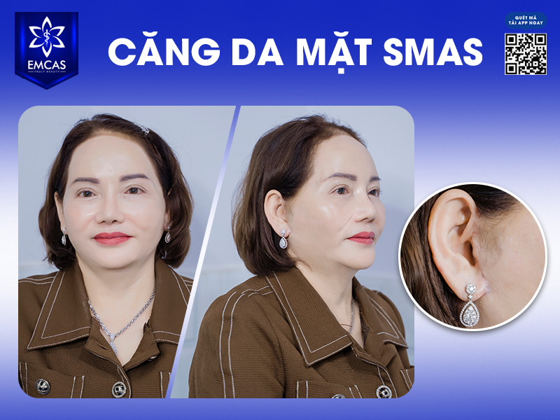 Căng Da Mặt SMAS - Bí Quyết Giữ Gìn Thanh Xuân